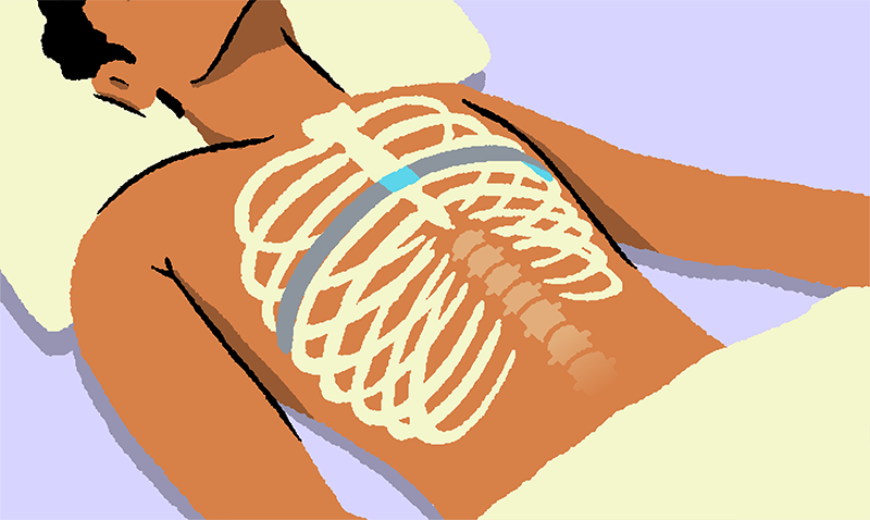 Pectus bar in chest nuss procedure