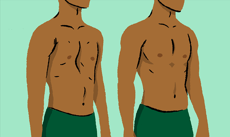 Pectus Excavatum Chest and Typical Chest