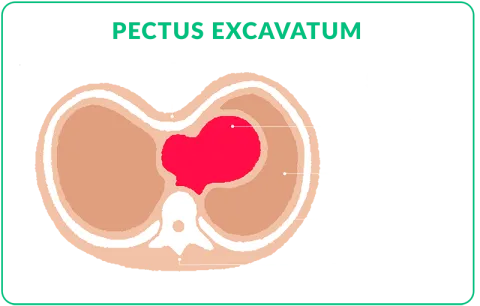 pectus excavatum cross section